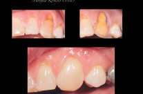 What problems are caused by teeth grinding?