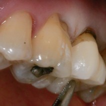 Single tooth restorations
