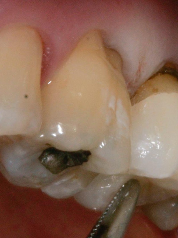Single tooth restorations
